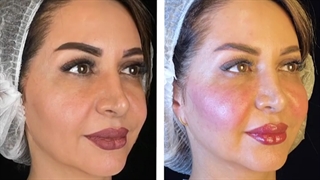 جوانسازی صورت