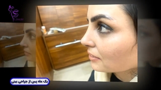 یک ماه پس از جراحی بینی