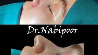 رینوپلاستی زیباجوی عزیز
