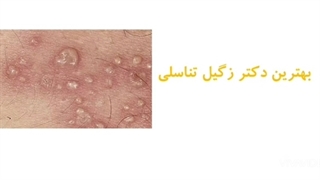 بهترین دکتر زگیل تناسلی