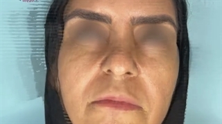 تزریق ژل به لب ها و خط خنده