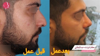 نمونه جراحی بینی مردانه در کرج