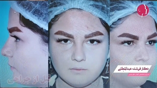 نمونه جراحی بینی گوشتی