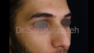 ▪️نمونه جراحی زیبایی بینی مردانه▪️