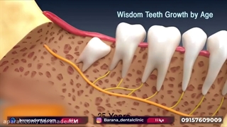 جراحی دندان عقل نهفته فک پایین