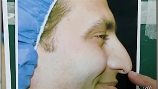 جراحی بینی با افتادگی شدید نوک بینی