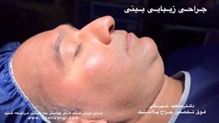 در طول ریکاوری جراحی بینی چه انتظاراتی باید داشت