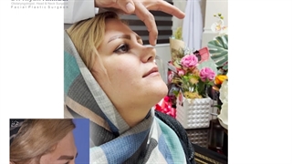 رضایت بیمار از عمل بینی - دکتر کیان احمدی