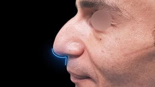 نمونه جراحی بینی آقایان