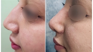 نمونه جراحی بینی توسط دکتر پریسا نظرپور تزریق ژل