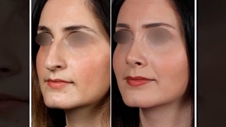 نمونه جراحی بینی توسط دکتر پریسانظرپور
