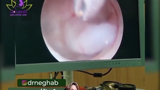 افزایش ضخامت اندومتر و پولیپ رحمی در خانومی در سن یائسگی