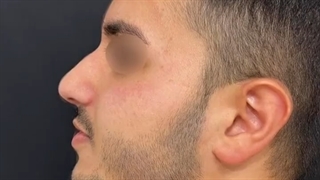 جراحی بینی مردانه