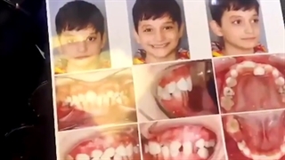 درمان کراس بابت دندانی