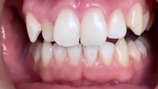 شروع درمان ارتودنسی