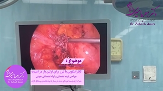 لاپاراسکوپی با لیزر