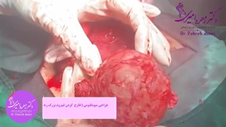جراحی میومکتومی (قسمت 2)