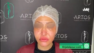 تزریق چربی صورت