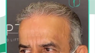 کاشت مو آقایان