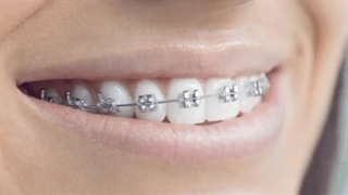 منظم کردن دندان با ارتودنسی
