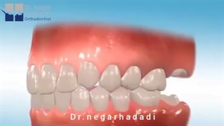 درمان فاصله دندانی