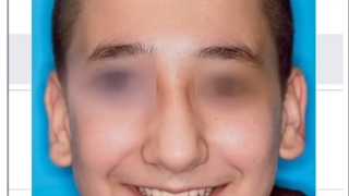 نمونه ارتودنسی توسط دکتر نگار حدادی پلاسماجت