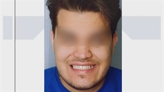 نمونه کار ارتودنسی توسط دکتر حدادی