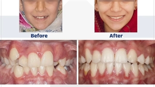 نمونه ارتودنسی در کودکان