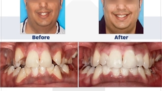 نمونه کار ارتودنسی ثابت