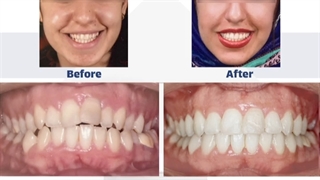 نمونه ارتودنسی دکتر نگار حدادی کلینیک مو