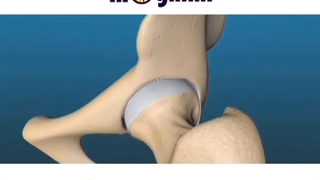 انیمیشن تعویض مفصل لگن