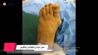 عمل جراحی هالوس والگوس