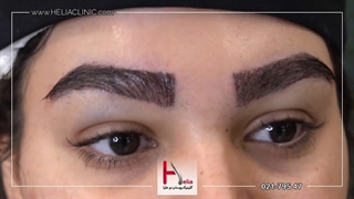 تغییر حالت چهره با کاشت ابرو طبیعی و پرپشت