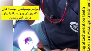 مراحل چسباندن اتچمنت های کامپوزیتی روی دندان ها برای بیمار اینویزلاین ما