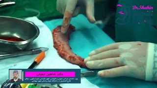 وسایل عمل جراحی چاقی که احتمالا اسمشون رو هم نشنیدی...