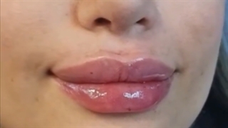 تزریق ژل لب روسی