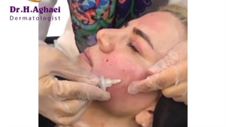 کربوکسی تراپی جهت جوانسازی پوست و برطرف کردن اسکار آکنه