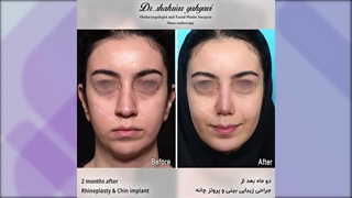 دو ماه بعد از جراحی زیبایی بینی و پروتز چانه