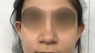 اتوپلاستی یا جراحی زیبایی گوش