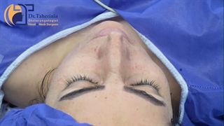 جراحی بینی گوشتی