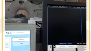 آشنایی با سی تی اسکن آنژیوگرافی کاروتید بخش دوم