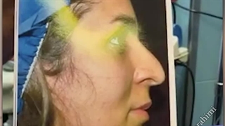 جراحی بینی قوزدار با افتادگی نوک بینی