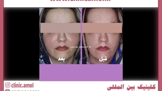 قیمت تزریق چربی به صورت ترمیم ونیر