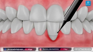 جراحی پیوند لثه چگونه انجام می شود؟ دندانپزشک زیبایی
