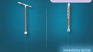 چگونه IUD در رحم قرار میگیرد؟