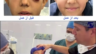 سینوزیت و آبسه کاسه چشم به دنبال آنفولانزا