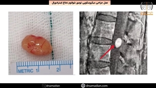 عمل جراحی میکروسکوپی تومور شوانوم نخاع اینترادورال