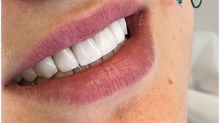 کامپوزیت ونیر ده دندان فک بالا با رنگ سفید صدفی