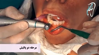 اصلاح طرح لبخند