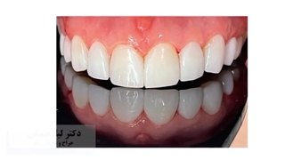 کامپوزیت ونیر ده دندان فک بالا با رنگ سفید صدفی